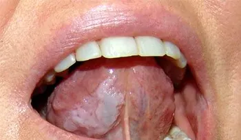 9 señales de tu lengua sobre problemas en su salud que no puedes ignorar