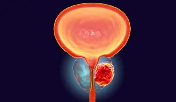 La apalutamida y enzalutamida prolongan la vida de pacientes con cáncer de próstata