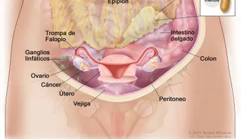 El cáncer de ovarios tiene mayor presencia en mujeres con endometriosis; una infección que afecta ovarios, trompas de Falopio y pelvis