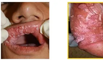 Condilomas genitales, causas y tratamientos
