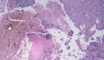 ¿Por qué el cáncer vuelve?