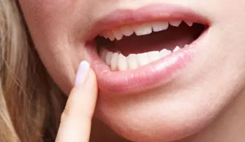 5 consejos para evitar aftas