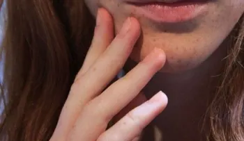 Tratamiento uñas quebradizas
