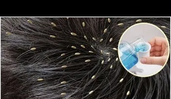 Los piojos huyen de esta mezcla con un solo lavado