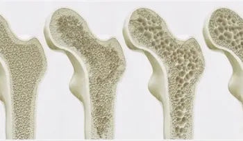 Usar bisfosfonatos para osteoroporosis aumenta el riesgo en enfermedad renal