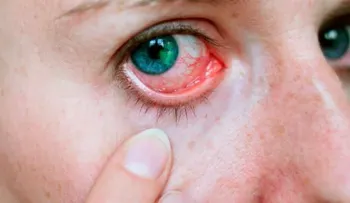 La abrasión o úlcera corneal