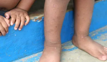 ¡Ojo! Repuntan casos de sarna por escasez de agua y jabón