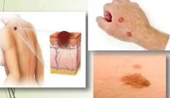 Recomiendan usar filtros solares para evitar el cáncer de la piel, que va en aumento en el país