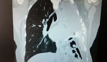 "Asesino invisible": un gas en muchos hogares podría causar cáncer de pulmón