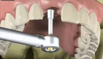 ¿Como se hace la prótesis sobre implantes dentales?