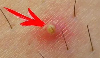 7 soluciones naturales para eliminar los pelos enquistados