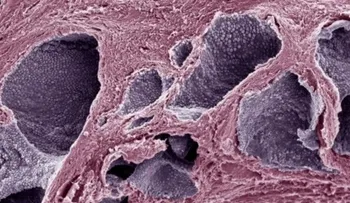La vitamina D limita la agresividad del cáncer de próstata