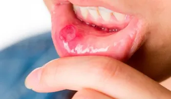 Un fármaco para tratar la psoriasis, demuestra ser muy eficaz en las úlceras orales 