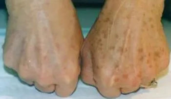 Esta crema quita las manchas desde su segundo uso, fácil, rápido y barato! 
