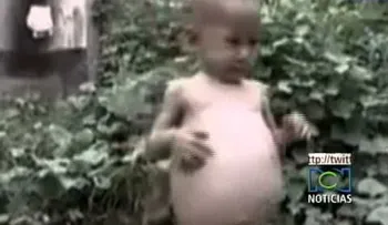 Revuelo en China por niña de 1 año embarazada de su propia gemela (VIDEO)