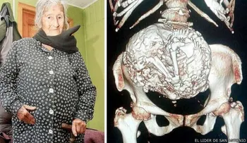 Una anciana tiene 60 años con un feto en su vientre 