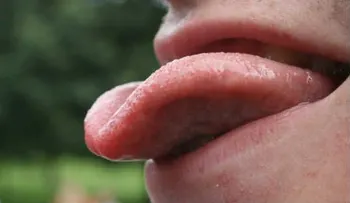 ¿Podría una lengua gorda ser un factor en la apnea del sueño?