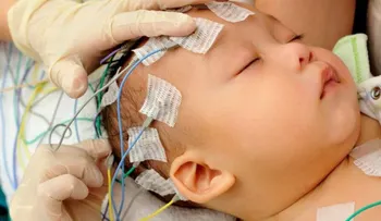 El síndrome de West, una enfermedad rara que afecta a unos 800 niños en Perú