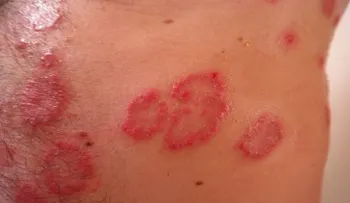 La psoriasis y sus formas de tratamiento: ácido salicílico y alquitrán de hulla