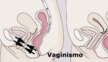 El vaginismo afecta a un 5% de las mujeres e impide que muchas parejas puedan tener sexo 