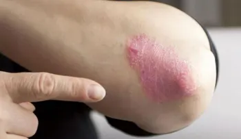 Artritis psoriática: Dolor articular debe ser tomado en serio