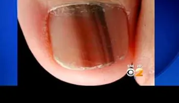 Si encuentras esta línea negra en tus uñas, esto es lo que significa! (VIDEO)