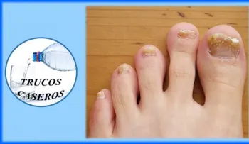 Fabrica tu propio "rompe hongos" para las uñas: Sorprendente resultado