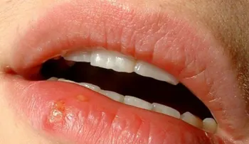 Primeros síntomas del herpes simple... ¿cómo controlarlo?