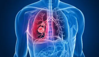 6 posibles causas de cáncer de pulmón que seguro no conocías