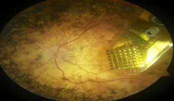 Por 100 mil euros implantan en Francia chips devuelve la visión a paciente ciego