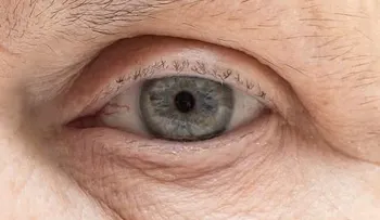 Las causas del derrame ocular y como tratarlo naturalmente