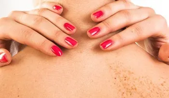Qué son las pecas y cómo cuidarlas correctamente