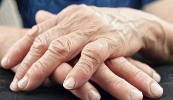 Factores que te ponen en riesgo de desarrollar artritis reumatoide