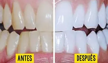 3 ingredientes mezclado y luego colocado en sus dientes...No podrás creer los resultados 