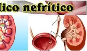 Cólico nefrítico: síntomas, causas y tratamiento
