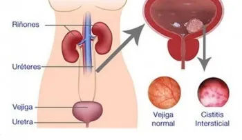 Cambios en tus hábitos para prevenir la cistitis