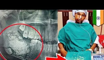 ¡Insólito! le sacan 232 dientes a joven