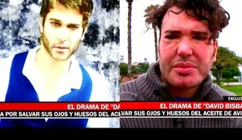 Quería parecerse a David Bisbal y le inyectaron aceite de avión (VIDEO)