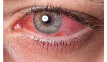 Remedios para la conjuntivitis: zumo de perejil; baños de plantas; lavados con eufrasia