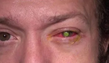 Este hombre despertó ciego, por un error más común de lo que crees