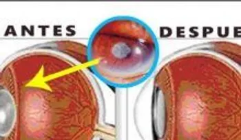 Recupera tu visión casi al 100% y tira tus lentes al zafacón con este remedio