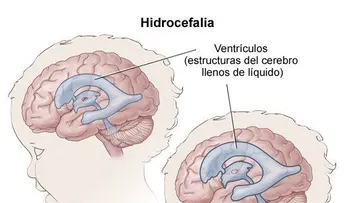 Cirugía endoscópica es una opción para tratar eficazmente la hidrocefalia 