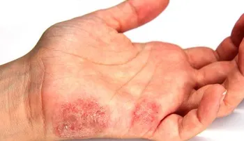 5 remedios caseros para la psoriasis