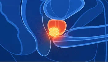 Cáncer de próstata: tratamiento en cinco sesiones