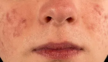 Aclara las marcas del acné con estos 4 remedios naturales