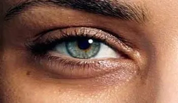La verdadera causa de las ojeras. ¿Tienes tú o alguno de tus hijos ojeras?