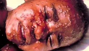 Alerta ante posibles casos de Ebola en Republica Dominicana