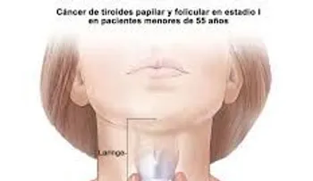 Síntomas "inofensivos", de un posible cáncer de tiroides. ¡No los dejes pasar!