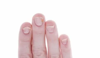 Manifestaciones en las uñas pueden dar indicio de la artritis psoriática