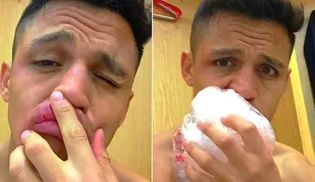 IMAGENES FUERTES: La espeluznante comparación de un ex rugbier para burlarse del golpe que sufrió Alexis Sánchez
